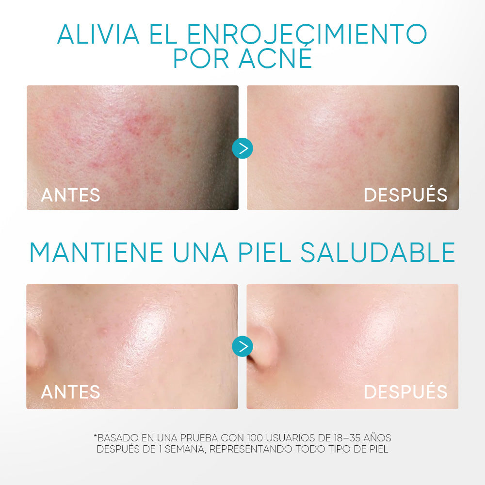 Gel Calmante para Acné con 5% de Pantenol